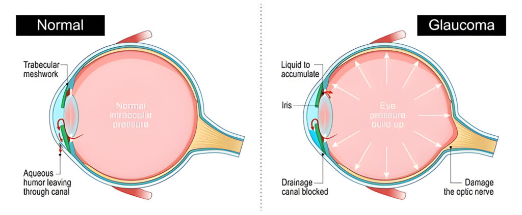 glaucoma-treatment