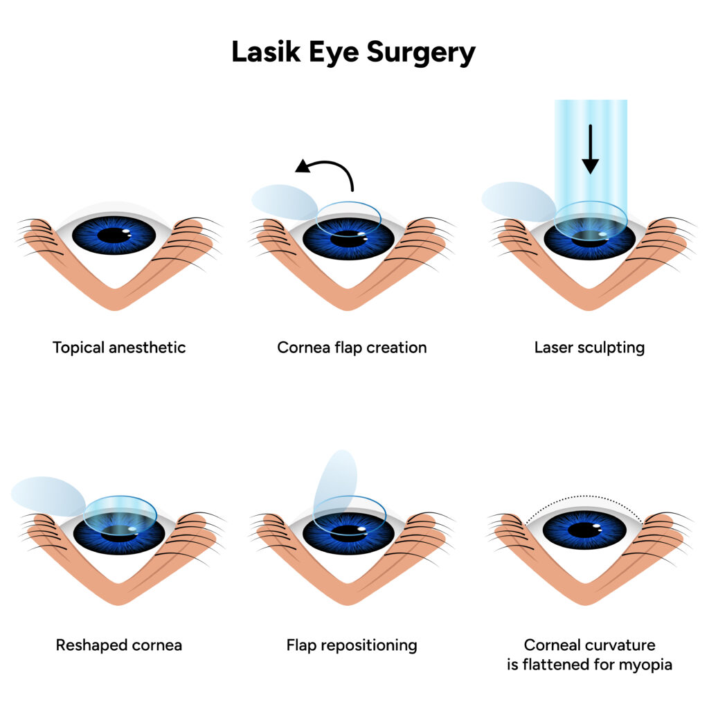 lasik eye surgery in jalandhar