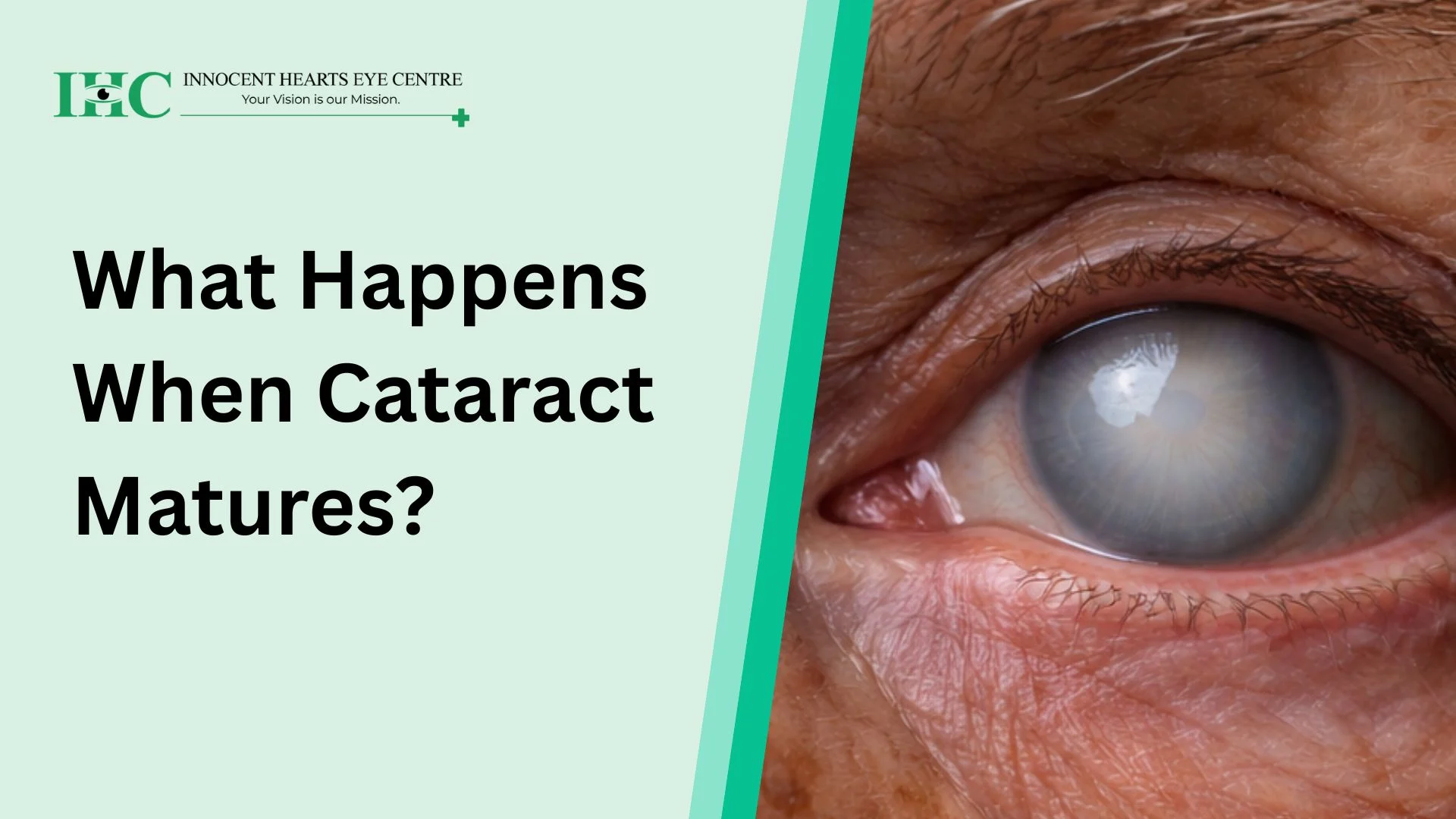 What Happens When Cataract Matures?