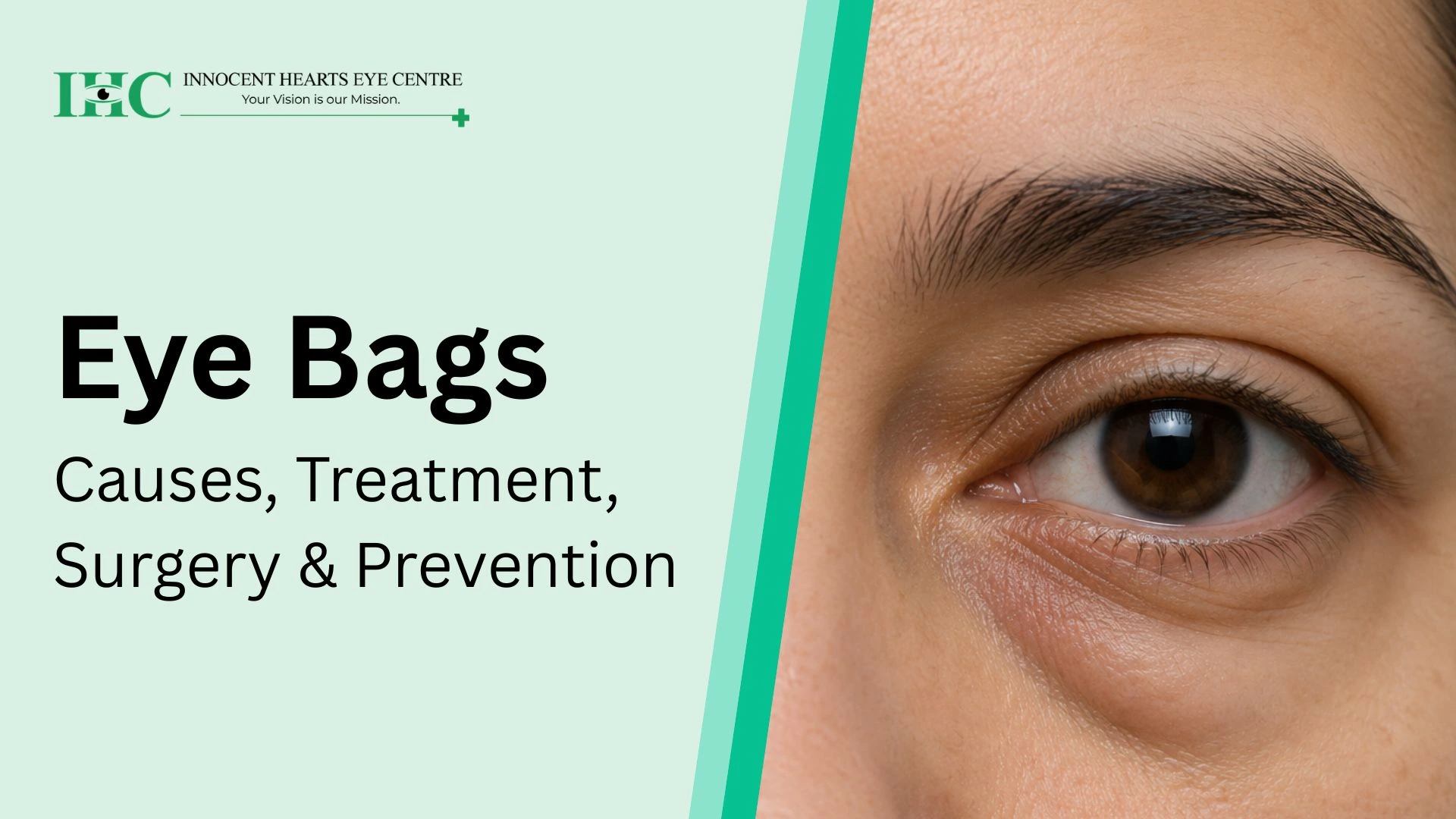 Eye Bags: Causes, Effective Treatments, and Prevention Tips