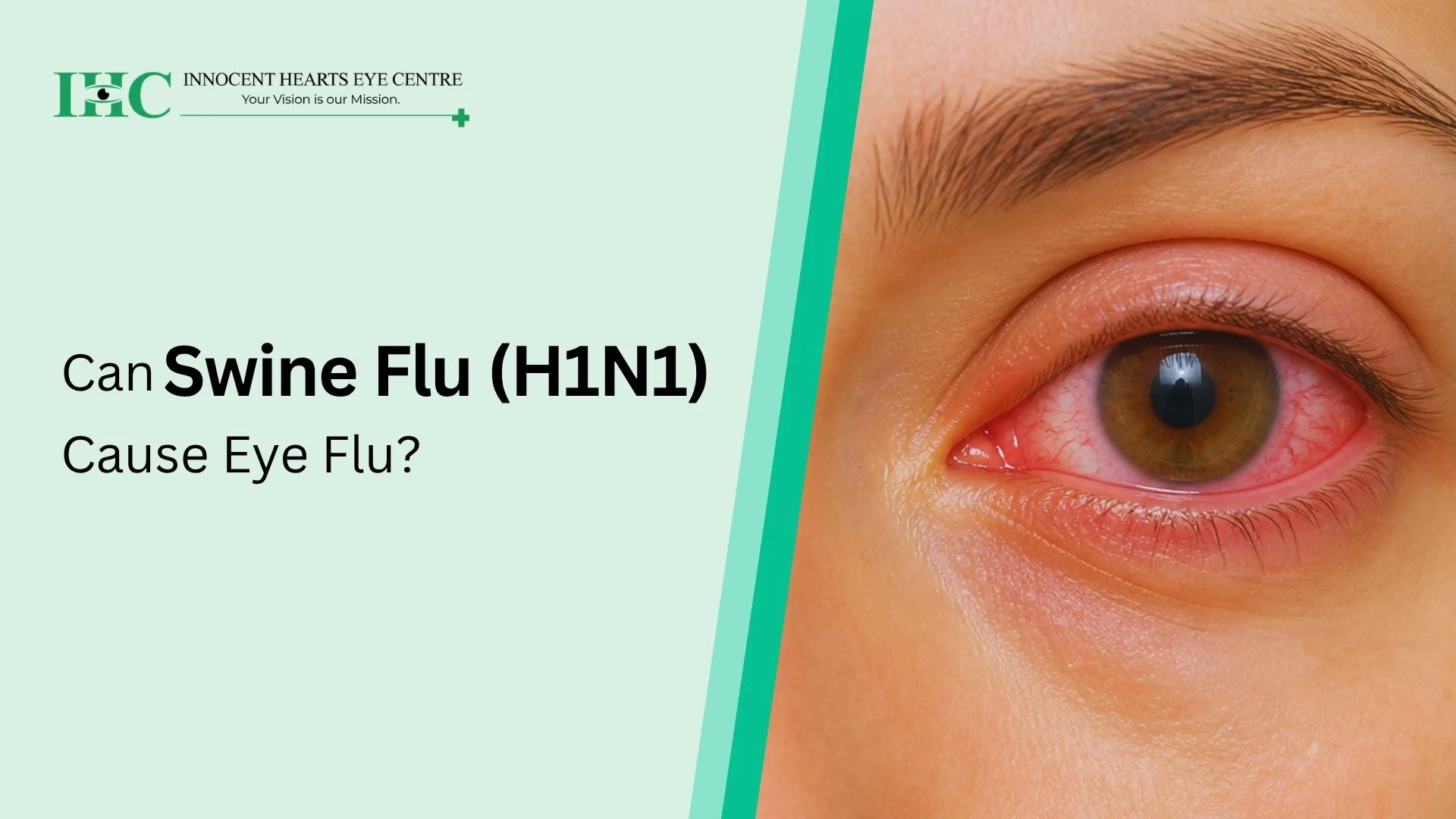 Can Swine Flu (H1N1) Cause Eye Flu?