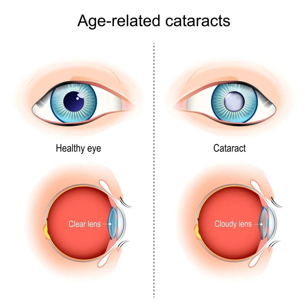 Age related cataracts