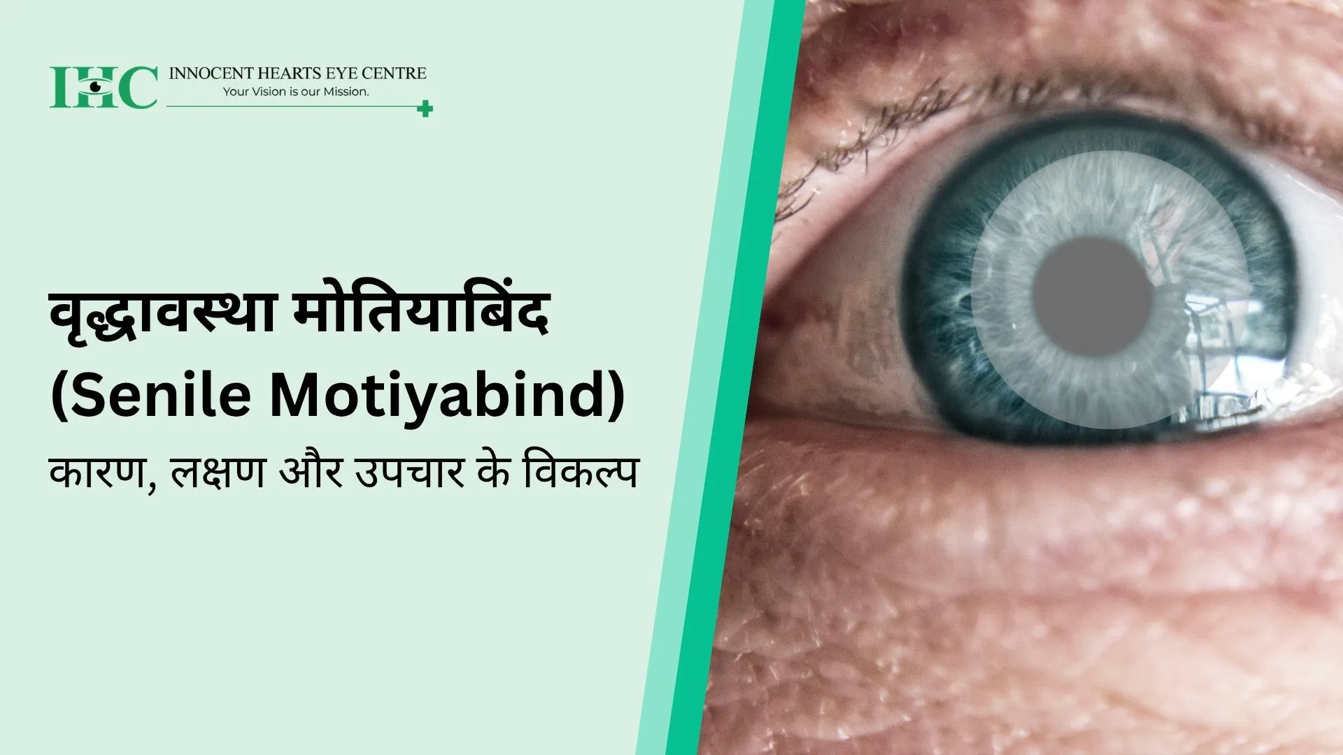 वृद्धावस्था मोतियाबिंद (Motiyabind): कारण, लक्षण, चरण और इलाज
